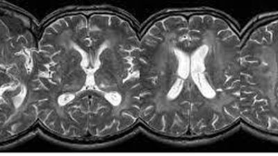 يصيب 1 من كل 40 ألف طفل.. تعرف على حثل المادة البيضاء