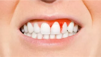 تحذير طبي: مرض لثة مؤلم جديد مرتبط بأكياس النيكوتين العصرية