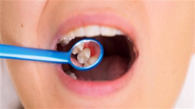 لا تفقد أسنانك.. علاج التهاب اللثة المثالي في المنزل بوصفات سهلة