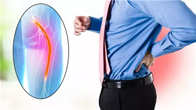 يحدث بسبب تضخم العظام.. تعرف على أبرز المعلومات عن مرض عرق النسا