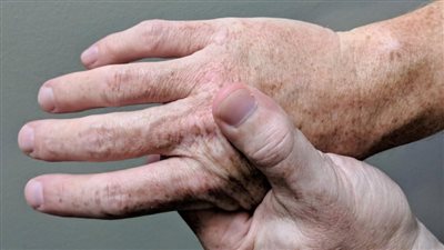 دراسة: خطر الإصابة بمتلازمة غيلان باريه تكون أكبر بعد الإصابة بفيروس كورونا