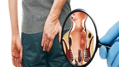 علاج يقضي على البواسير نهائيا.. الحل في الليزر