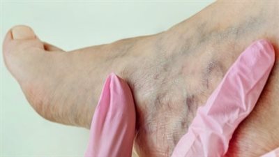 5 نصائح للوقاية من تجلط الأوردة العميقة.. تعرف عليها