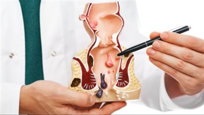 علاج البواسير في يوم واحد.. أبرزها حمام ساخن