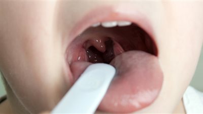 بعد استئصالهما بـ 40 عامًا.. نمو نادر للوزتين يعيد امرأة لإجراء جراحة جديدة