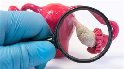 دراسة توضح العلاقة بين متلازمة تكيس المبايض وزيادة خطر الانتحار لدى النساء