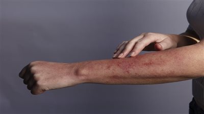 الهيدروجيل يساهم في شفاء الآفات الجلدية لدى مرضى السكر| دراسة