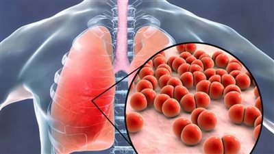 تورم الغدد والمفاصل.. تعرف على أعراض السل  