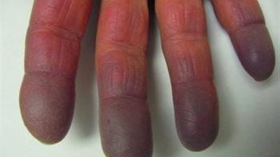 مع اقتراب العلماء من علاج برودة الأيدي المزمنة.. علاجات سريعة للإصابة بداء رينود 