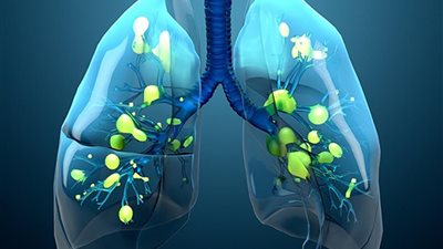 نقطة تحول.. أمل جديد لمرضى التليف الكيسي الشباب في إنجلترا
