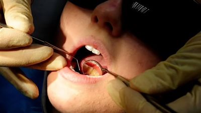 نصائح لـ الفحص الذاتي المنتظم للكشف عن سرطان الفم