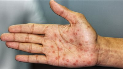 متوقع استمرار الارتفاع.. ولاية أمريكية ترتفع بها معدلات مرض الزهري بنسبة 800% 