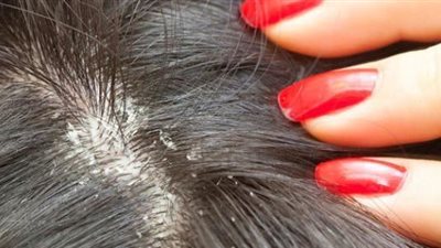 تفسير حلم القمل في المنام.. احذر الأصدقاء المخادعة في حياتك