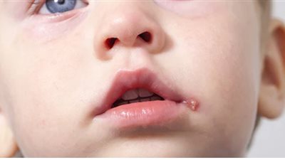 عدوى الهربس بين الأطفال.. استشاري حساسية يوضح أعراض وأسباب انتقال الفيروس