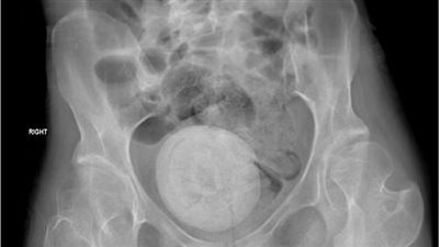 حالة طبية نادرة.. اكتشاف حصوة مهبلية بحجم برتقالة كبيرة في حوض امرأة