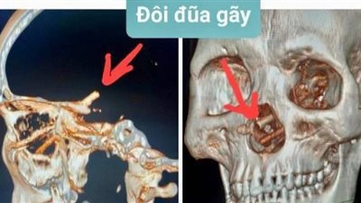 لم يتذكر ما حدث.. الأطباء يعثرون على أجسام غريبة داخل جمجمة رجل بعد شهور من المعاناة