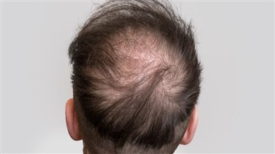 دراسة: مكون شائع في الحلويات والمشروبات الغازية قد يفتح باب الأمل لعلاج الصلع