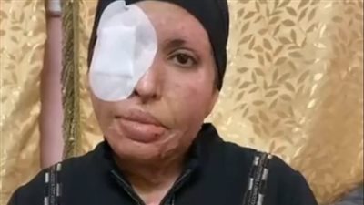 سيدة تعدي زوجها عليها بمياه نار: محتاجة عملية تجميل علشان أشتغل وأصرف على ولادي | بث مباشر