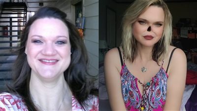 بسبب السرطان.. سيدة أمريكية تخضع لعملية استئصال الأنف بالكامل