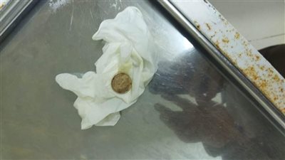 إنقاذ طفل بلع نصف جنيه معدن من الموت في المنوفية