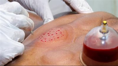 أفضل أيام الحجامة في الإسلام.. حكمها ووقتها وفقًا للأحاديث النبوية