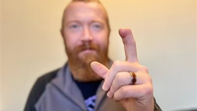 الأولى من نوعها.. عملية لساعي بريد لإعادة بناء إصبعه باستخدام إصبع قدمه