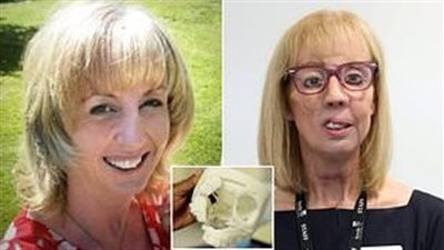 كانت تعاني من أعراض البرد.. إصابة سيدة بورم سرطاني نادر في الأنف