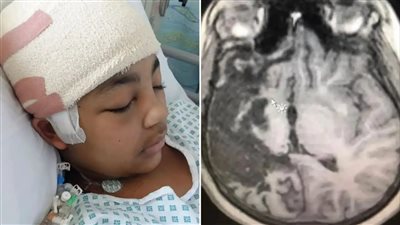 سيدة بريطانية تتخذ قرار بإيقاف نصف دماغ ابنتها بعد إصابتها بمرض نادر