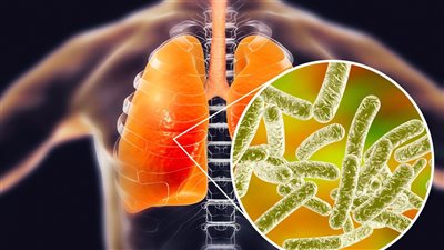 مراكز السيطرة على الأمراض تكشف عن سبب انتشار مرض الفيالقة في كاليفورنيا