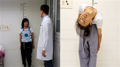 منحني بزاوية 180 درجة.. امرأة صينية حياتها تتغير بسبب عملية جراحية في العمود الفقري