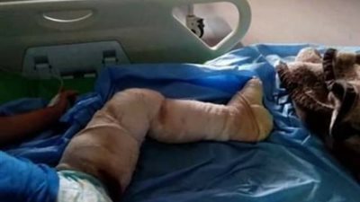 انتقاما من والده.. ثلاث شباب يشعلون النيران فى جسد طفل بالمحلة (صور)