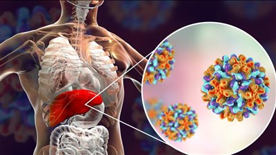 يصيب 3500 شخص يوميا.. خبراء يدعون لـ إعلان حالة الطوارئ بدول آسيوية بسبب التهاب الكبد
