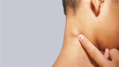 تعرف على أعراض الإصابة بسرطان الغدد الليمفاوية وطرق العلاج المناسبة