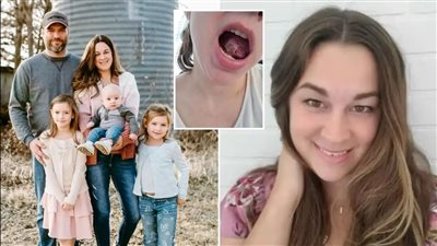 قرحة في اللسان.. إصابة سيدة أمريكية بورم سرطاني نادر في الفم