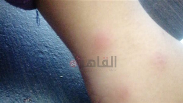 إصابات الطلاب نتيجة