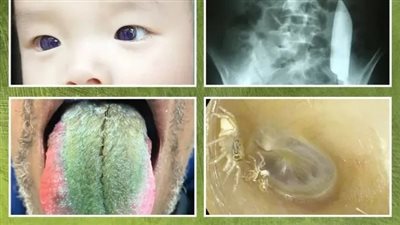 حصاد أغرب الحالات الطبية لعام 2023.. أبرزها ظهور فرو أخضر على لسان رجل