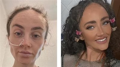 كاد أن يتوقف قلبها.. أطباء ينجحون في علاج مريضة عانت من اضطراب الأكل خلال جائحة كورونا