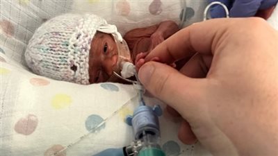 طفلة معجزة بوزن نصف كيلو.. تعرف على قصتها