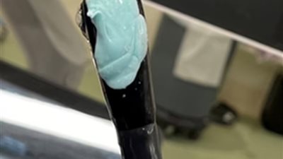 كاد يموت بجلطة.. أطباء ينجحون في إزالة علكة من حلق مريض بريطاني