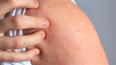 بسبب نقص الأدوية.. انتشار الجرب يثير القلق في بريطانيا 