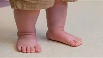 الرعاية الصحية: علاج قصر أحد الطرفين السفليين بمستشفيات التأمين الصحي الشامل ببورسعيد