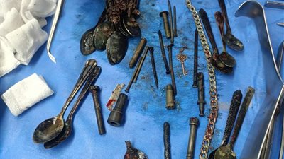 استخراج معالق ومسامير من أمعاء مريض بالمنوفية