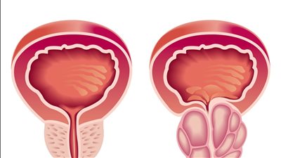 ما هو تضخم البروستاتا وأعراضه؟