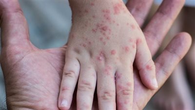 ولاية كانساس الأمريكية تعلن تفشي مرض الحصبة