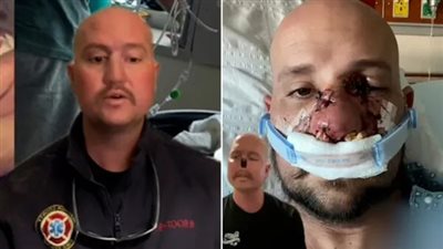 عدوى بكتيرية تتسبب في بتر أنف أمريكي