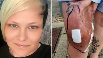 أجرت 55 عملية جراحية.. سيدة بريطانية تفقد ساقها بسبب صنارة صيد