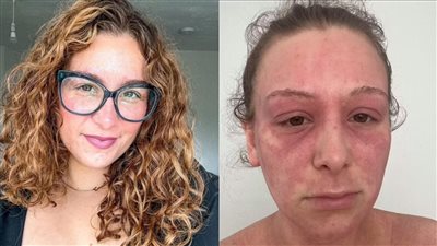 بسبب حليب الحمير.. فتاة أمريكية تتعافى من آثار الإكزيما المؤلمة