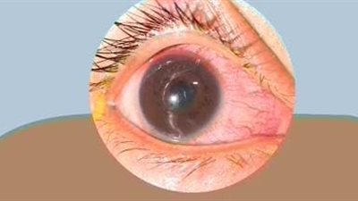 أبرزها احمرار العين والصداع.. تعرف على أسباب وأعراض التهاب القزحية