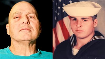 بعد تعرضه للإشعاع في الثمانينات.. وفاة رجل أمريكي بسرطان نادر