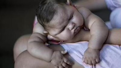 في اليوم العالمي للعيوب الخلقية.. نصائح مهمة يجب معرفتها